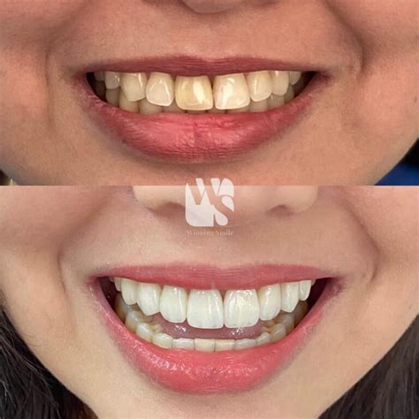 Dental Veneers in the Philippines: Benefits, Types, .